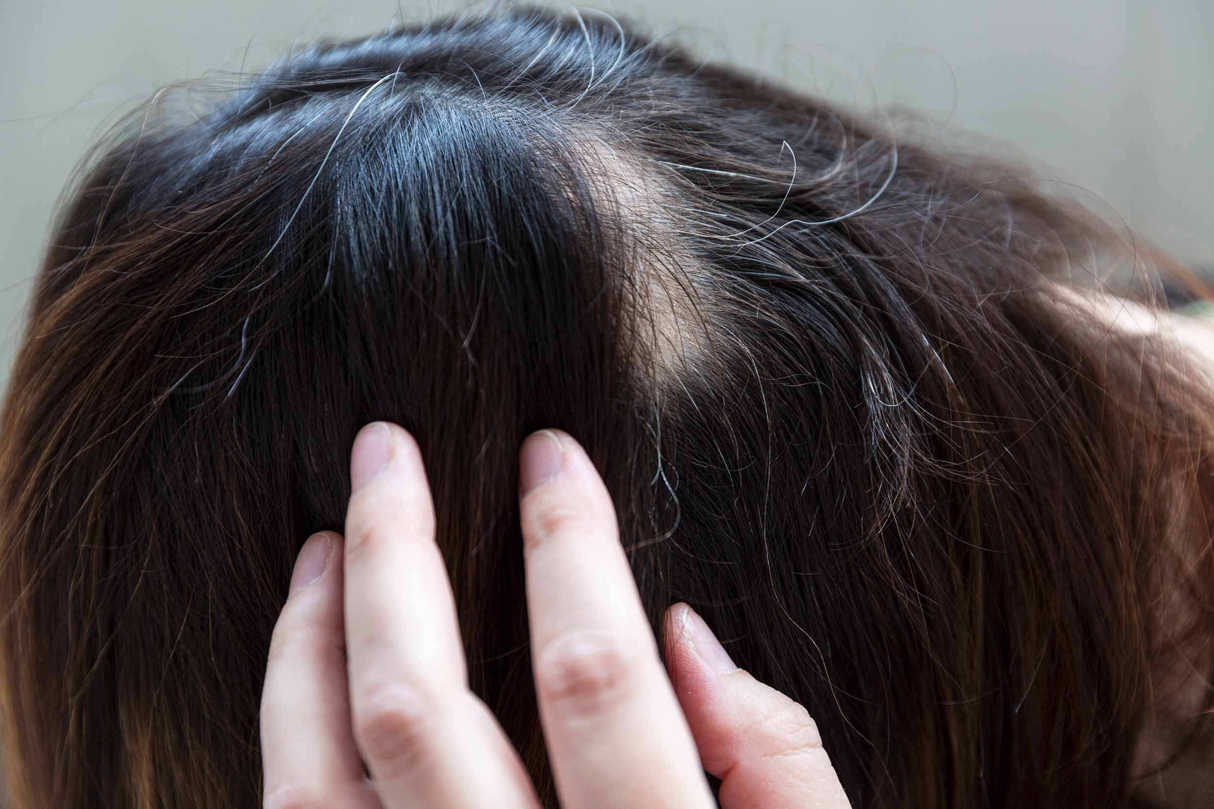 how to stop alopecia areata from spreading